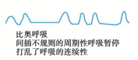 Biot呼吸示意图